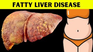 The Ultimate Guide to Understanding Fatty Liver Disease Everything You Should Know About Fatty Liver [upl. by Osicnarf]