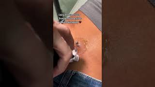 Piercing Migration Treatment  Piercing Bump Removal ft Base Laboratories Piercing Bump Treatment [upl. by Bevis]