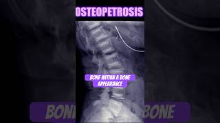 Osteopetrosis bones radiology doctor [upl. by Htial]