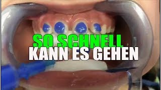 SO SCHNELL wird die FESTE ZAHNSPANGE eingesetzt  Orthodentix [upl. by Sergo]