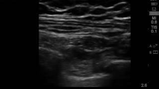 ultrasound guided intercostal nerve block 2 [upl. by Ecydnac101]