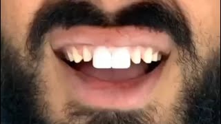 CHANGING MY CROWNS IN TURKEY veneers teeth dentist dentalcentreturkey turkey whiteteeth [upl. by Eissoj]