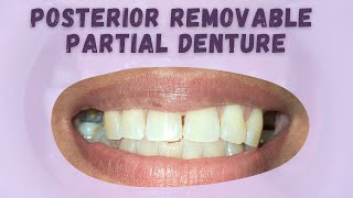 WDCPOSTERIOR REMOVABLE PARTIAL DENTURE FOR MASTICATORY FUNCTION [upl. by Cohbert259]