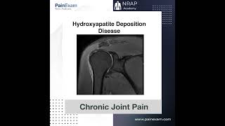 Hydroxyapatite Deposition Disease [upl. by Brewer]