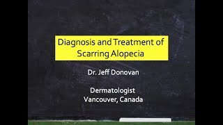 Diagnosis amp Treatment Scarring Alopecia [upl. by Blaire884]