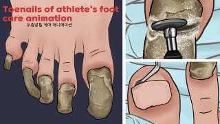 ASMR Satisfying Toenail of Athletes foot Treatment animation  Athletes foot foot care  TINGLES [upl. by Niletac]