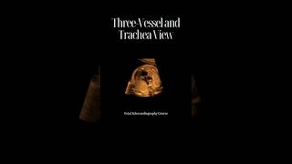 Unlocking the Secrets of the ThreeVessel and Trachea View in Fetal Echocardiography [upl. by Arrio682]