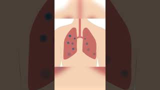 Severe RSV Symptoms [upl. by Photima]