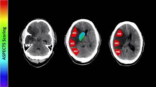 Perfusion Imaging Part 1  Free Radiology CME [upl. by Ma]