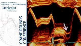 Update on Mitral Valve Prolapse A Jamil Tajik MD January 24 2019 [upl. by Sedrul23]