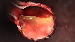 Endoscopy of Multiple Ulcers of the Stomach [upl. by Egin]