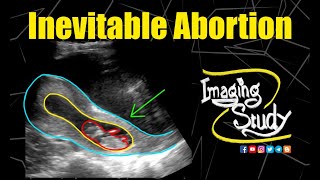 Inevitable Abortion  Ultrasound  Case 208 [upl. by Cormick]