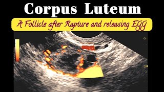 Ovulation study  Corpus Luteum  Ultrasound Raptured Follicle in 3 Patients [upl. by Irrak134]