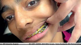 Forsus Appliance in Orthodontics  Dr Kapil Saroha BDS MDS [upl. by Lyudmila]