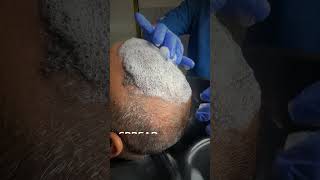 1st Head Wash After 10 Days of Hair Transplant  Post Care [upl. by Comras306]