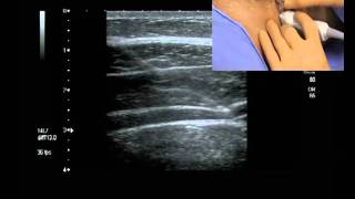 Transverse Abdominis Plane Block ultrasound guided [upl. by Bertrand22]