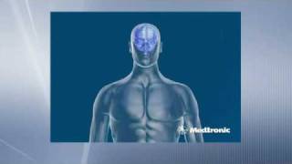 Deep Brain Stimulation  How does DBS work [upl. by Eisler]