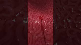 Bleeding gastric ulcer 3d animation anatomy meded [upl. by Pronty777]