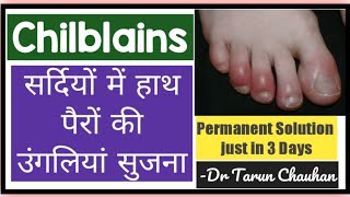 Top Homeopathic medicines  सर्दियों में हाथ पैरों की उंगलियों में सूजन amp खुजली  chilblains [upl. by Spiegel211]