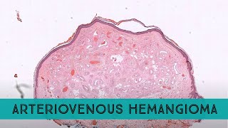 quotArteriovenousquot Hemangioma pathology dermpath dermatology dermatopathology [upl. by Felipa]