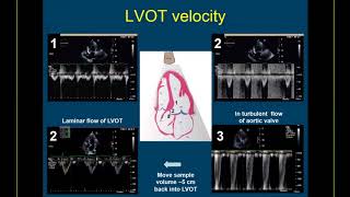 Guidelinebased Webinar on the Echo Assessment of Aortic Valve Stenosis [upl. by Lednor]