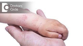 How to manage Atopic Dermatitis in children  Dr Divya Sharma [upl. by Burrow]