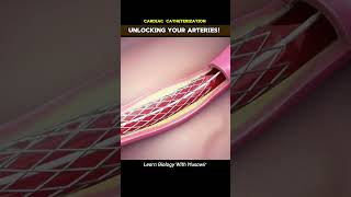 unlocking Your Arteries Cardiac Catheterization cardiology [upl. by Greeley]