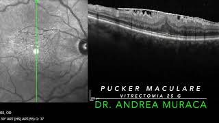 PUCKER MACULARE  MEMBRANA EPIRETINICA DR ANDREA MURACA [upl. by Barker675]