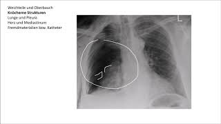 Röntgen Thorax Befundung [upl. by Titus]