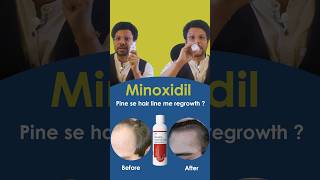 Minoxidil pine se hair line me regrowth hairfalltreatment hairlosssolution hairgrowthchallenge [upl. by Occir]