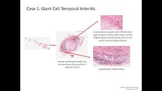 LG30 Vasculitis Patient Scenario with Slide Review 10 Min [upl. by Catha]