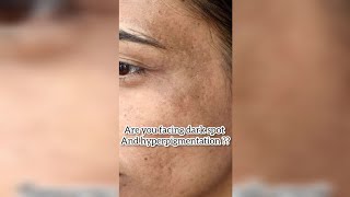 3 products to remove Acne spots Dark spots Pigmentation Uneven skin tone skincaretipsofficial [upl. by Haisi]