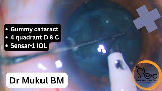 4 quadrant DampC technique  Is it efficient in gummy cataract [upl. by Feltie640]