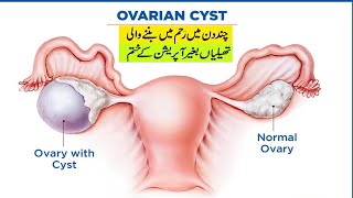 Ovarian cyst treatment without surgery with tibb e nabawi [upl. by Bohman62]