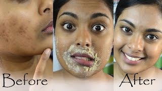 How To Get Rid Of Hyperpigmentation Dark Upper Lip Dark Spots amp Acne Scars Naturally At Home [upl. by Lah502]