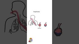 Crepitação pulmonar na ausculta O que é Pq ocorre [upl. by Lucie45]