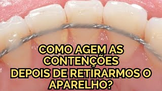 Como funcionam as contenções ortodônticas e por que elas nunca devem ser evitadas  Aula 215 [upl. by Ynaffital451]