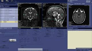 BRAIN MRV Planning with GE Scanner [upl. by Aldridge]