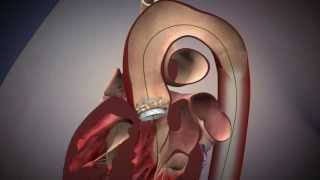 TAVR Edwards Sapien Aortic Valve Deployment [upl. by Sicard]