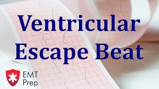 Ventricular Escape Beat ECG  EMTprepcom [upl. by Komsa]