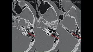 K  ENT Innovative Master Class 2020 Part 1 Basics of HRCT Temporal Bone [upl. by Huei348]