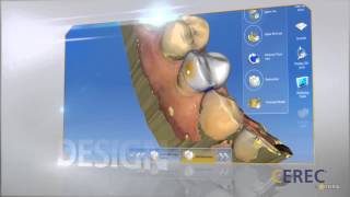 CEREC Dental Restorations [upl. by Dewie]