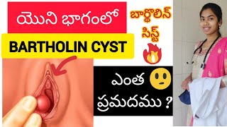 bartholin cyst in telugu  Bartholin gland [upl. by Fishbein815]