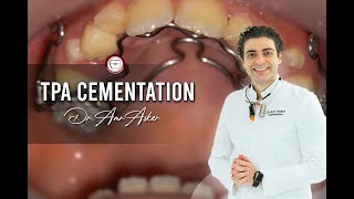 TPA transpalatal arch cementation in orthodontics [upl. by Brunhild]