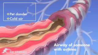 Asthma Medical Animation [upl. by Porter184]