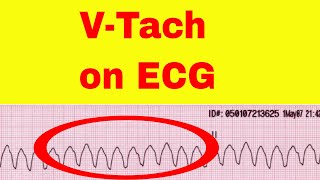 Ventricular Tachycardia on ECG [upl. by Vedette]