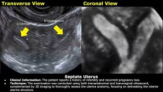 Congenital Uterine Anomalies Ultrasound Reporting  Didelphys Bicornuate Unicornuate Uterus USG [upl. by Ridglea]