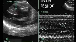 Tetralogy of Fallot with Vertically Oriented PDA [upl. by Godrich]