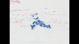 Parotid mass Acinic cell carcinoma Alcoholfixed smear [upl. by Levana]