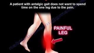 Antalgic Gait  Everything You Need To Know  Dr Nabil Ebraheim [upl. by Jeno]